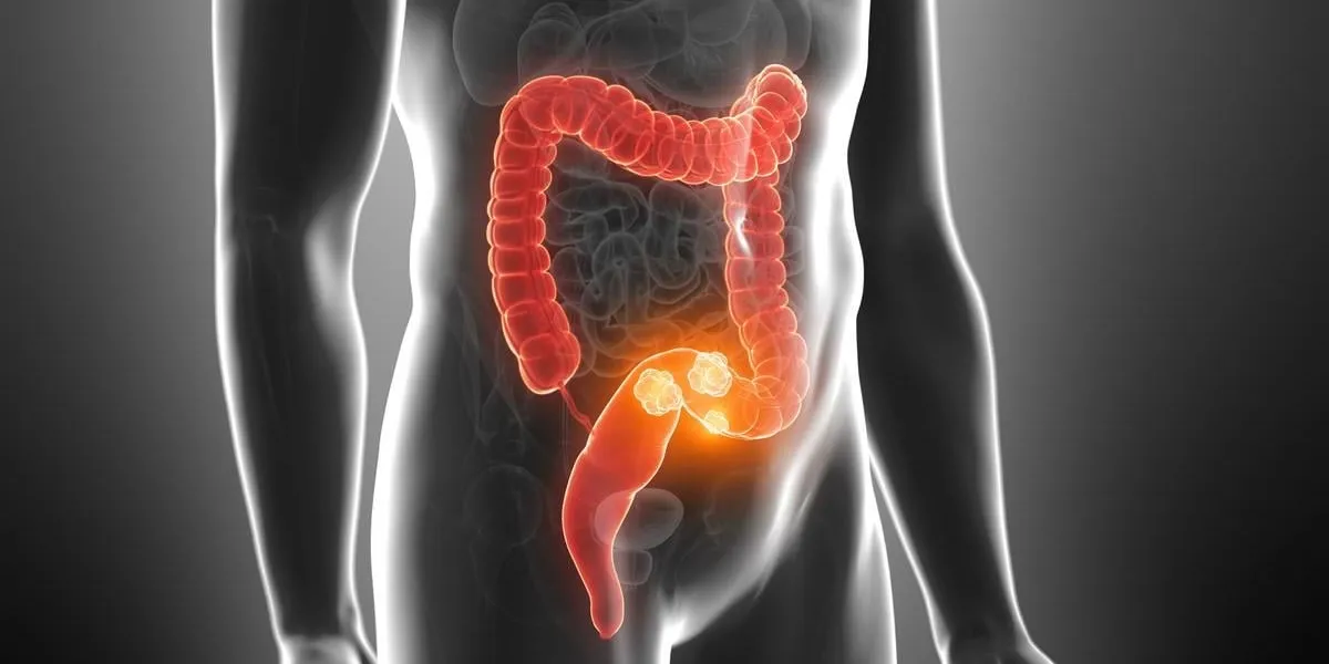 3d rendered medically accurate illustration of colorectal tumor