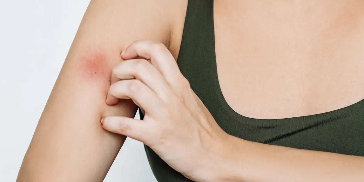 cropped shot of a young woman scratching an insect bite on her arm red rash caused by allergy, inflammatory process eczema, atopic dermatitis, lichen, allergy, itching, urticaria, psoriasis
