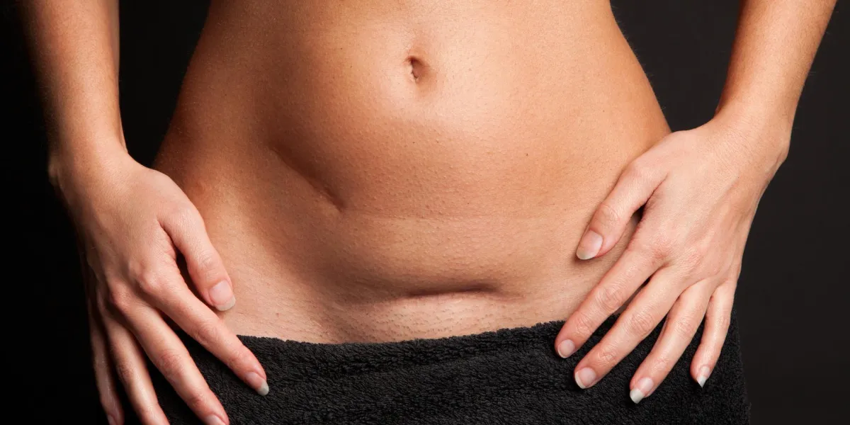 ventre d'une jolie femme avec des cicatrices