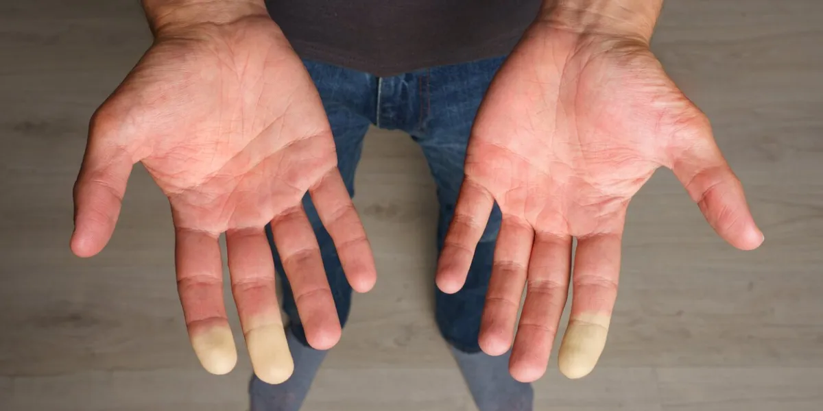 man showing hands with raynaud syndrome, raynaud's phenomenon or raynaud's disease high quality photo