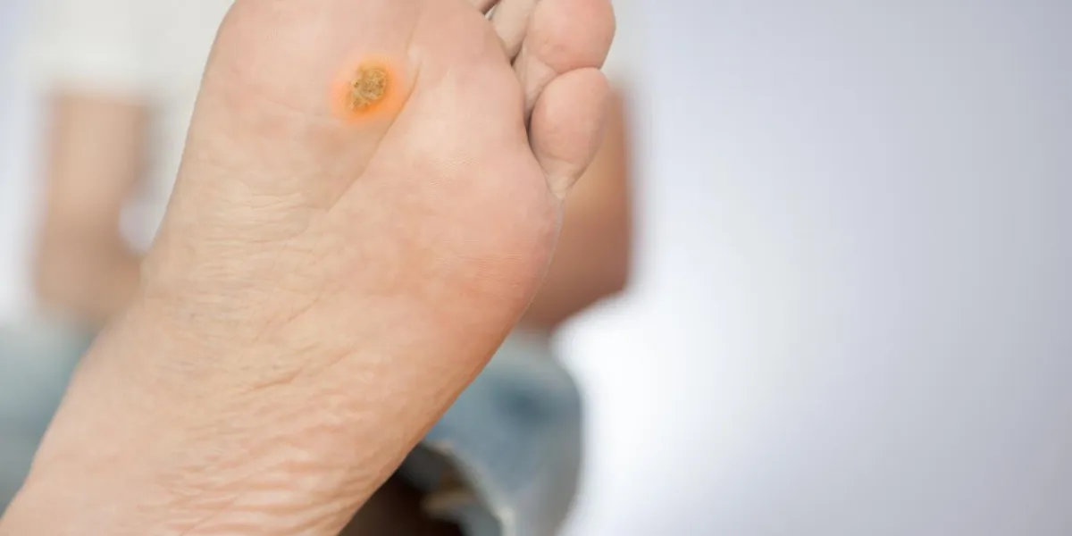 medical consultation at the removal of wart