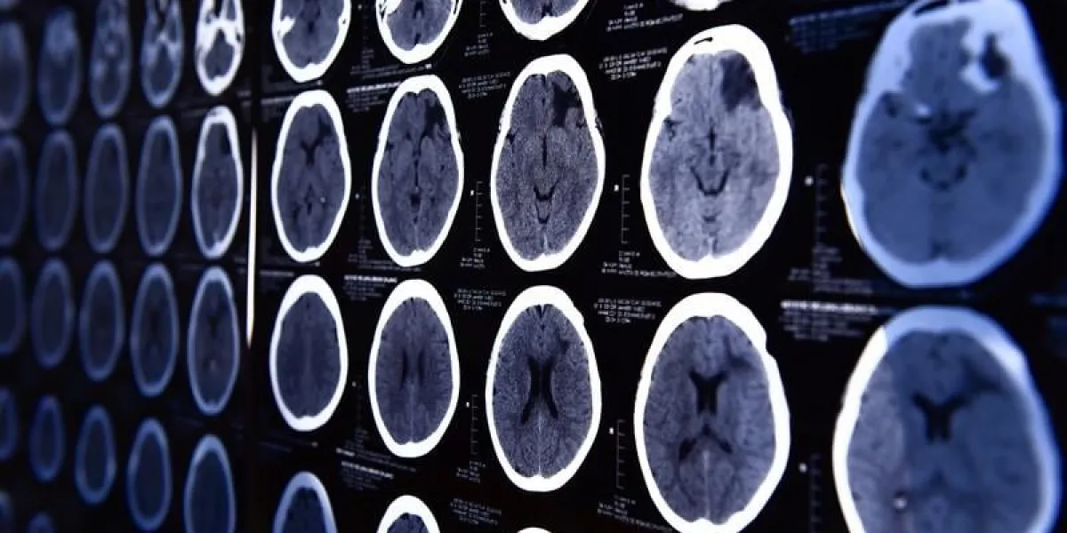 images from a computerized tomography of the brain