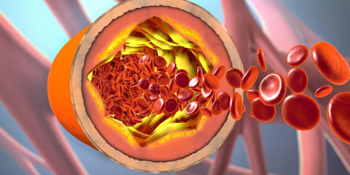 3d illustration of a precipitated and narrowing blood vessels or arteriosclerosis