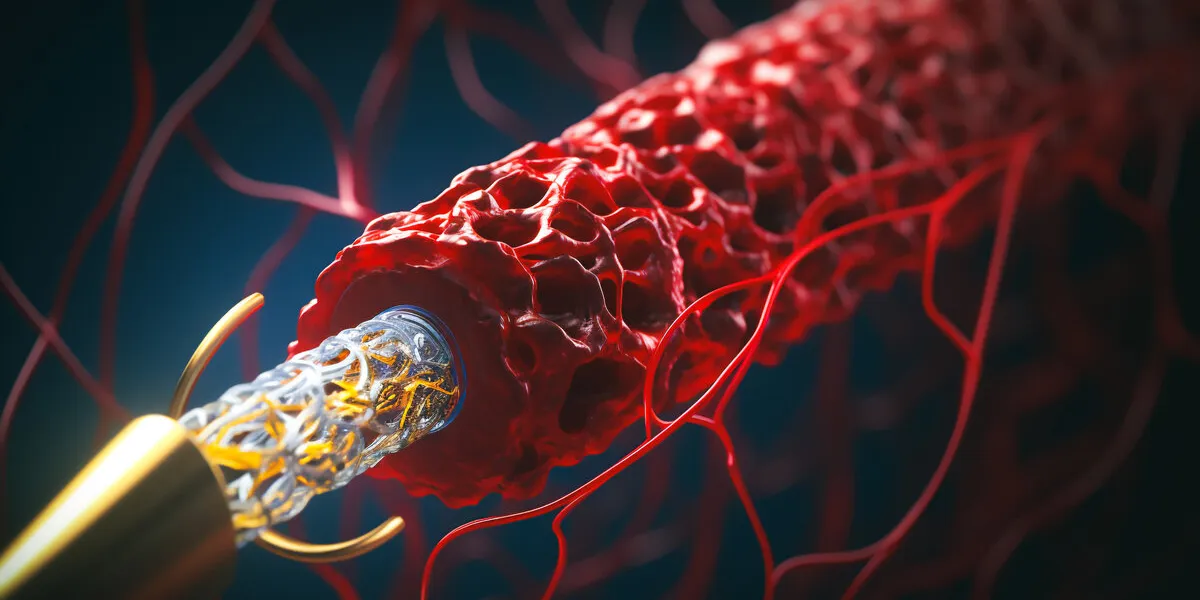 the image displays a close-up view of a stent retriever in action, positioned within a blood vessel to retrieve a clot