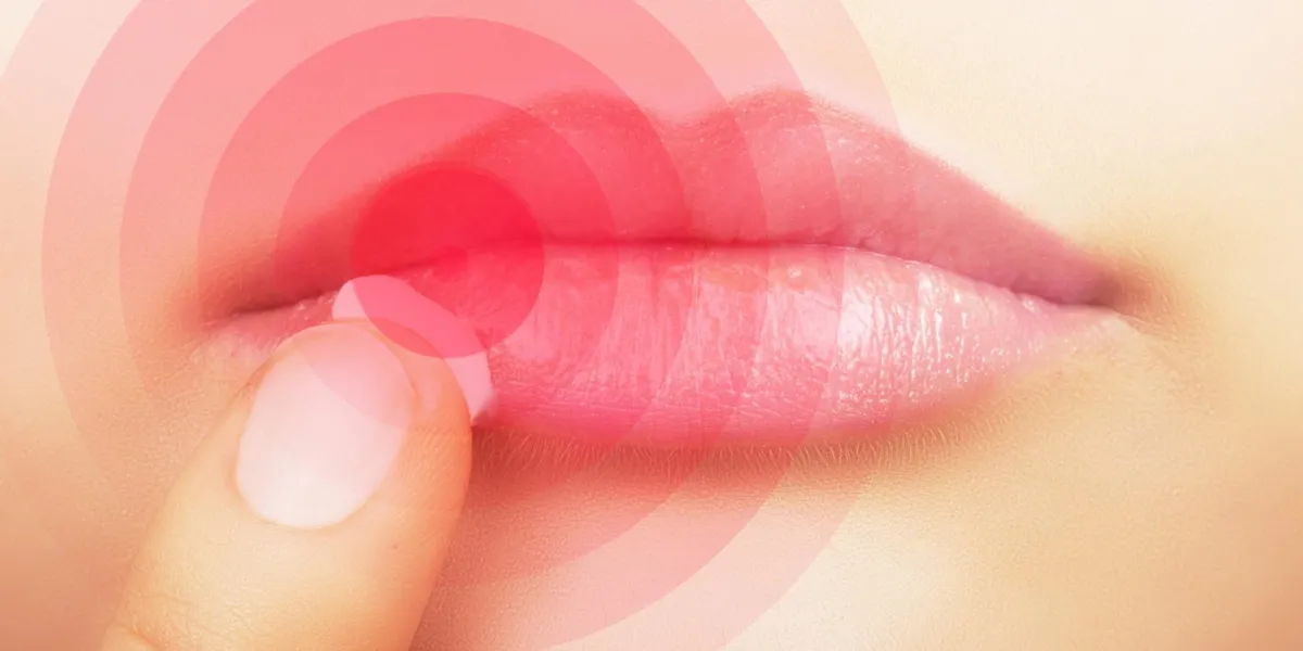 femme appliquant la crème sur les lèvres affectées par l'herpès, montré en rouge
