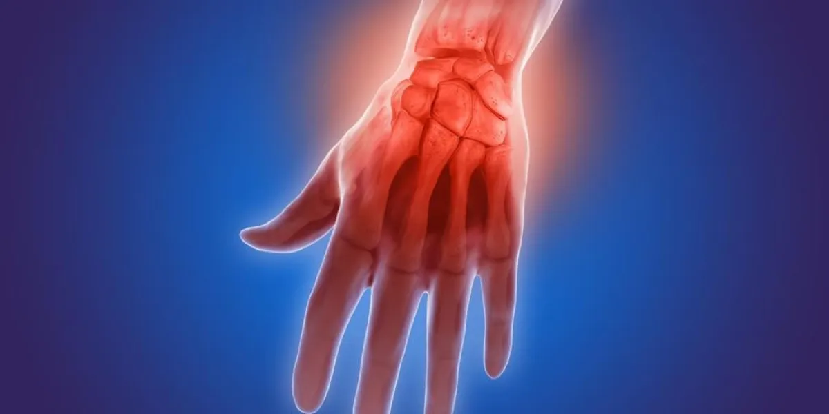 illustration 3d qui montre la douleur de l'arthrite dans le poignet et les doigts du poignet