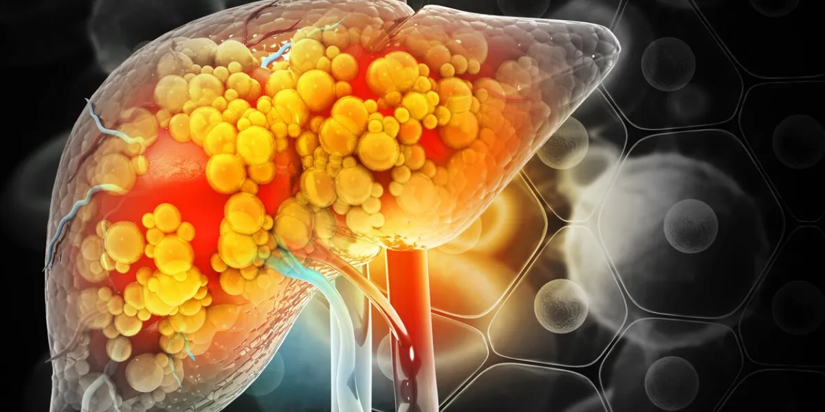 liver damage such as fatty liver, fibrosis, cirrhosis, and liver cancer 3d illustration