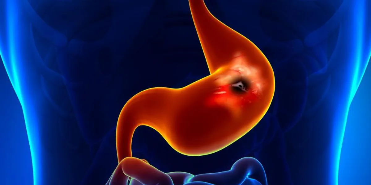 ulcère gastroduodénal