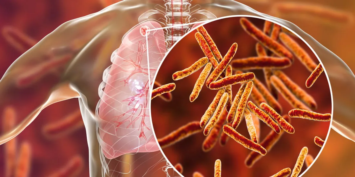 secondary tuberculosis in lungs and close-up view of mycobacterium tuberculosis bacteria, 3d illustration