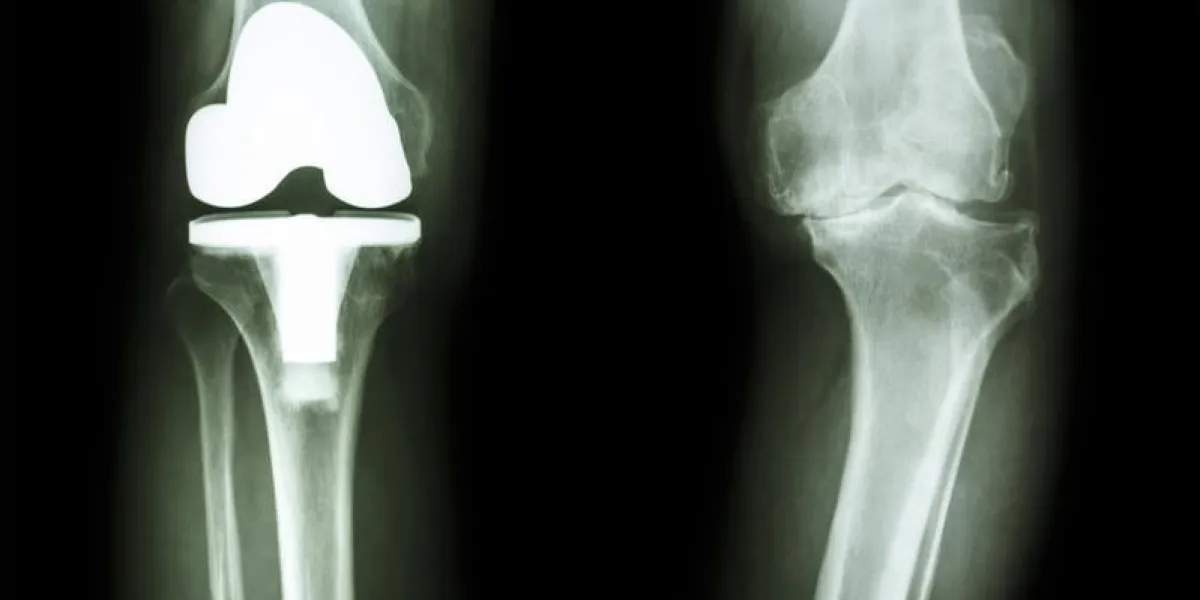 film radiographie du genou de l'arthrose patient du genou et articulation artificielle