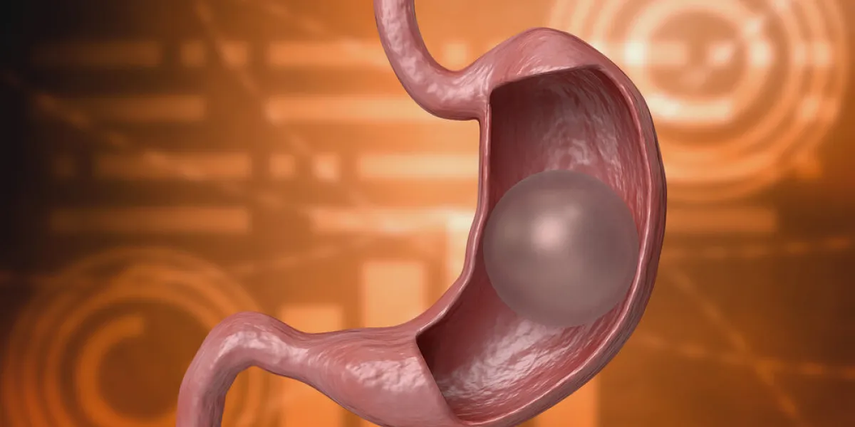 balloon gastric 3d rendering inflatable device that is placed in the stomach to reduce weight