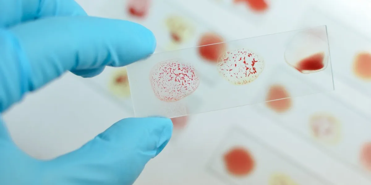 blood group testing by slide agglutination method