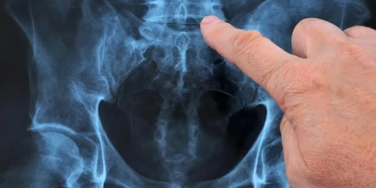 radiographie du rachis dorso-lombaire