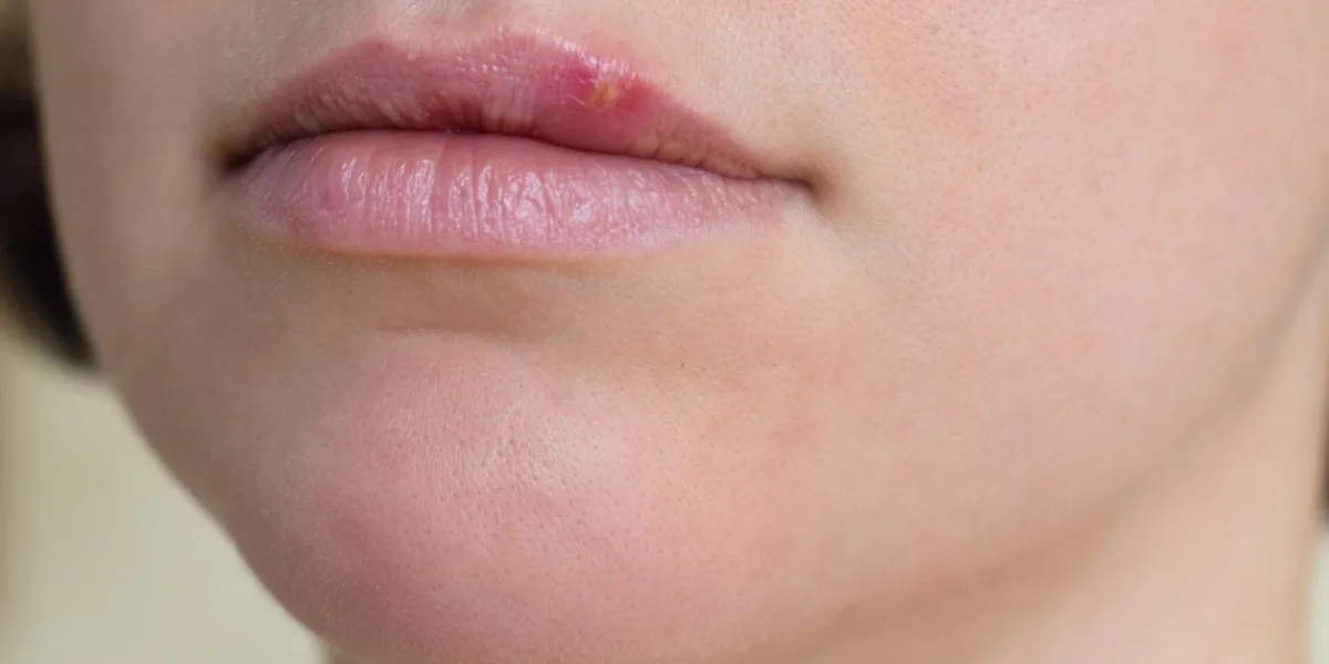 gros plan des lèvres féminines souffrant d'herpès