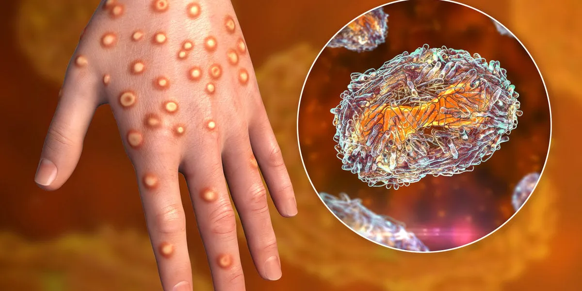 hand of a patient with monkeypox infection, 3d illustration monkeypox is a zoonotic virus from poxviridae family, causes monkeypox, a pox-like disease