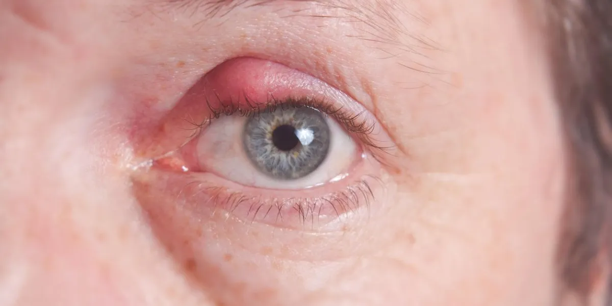 gros plan d'un oeil enflammé avec un orgelet