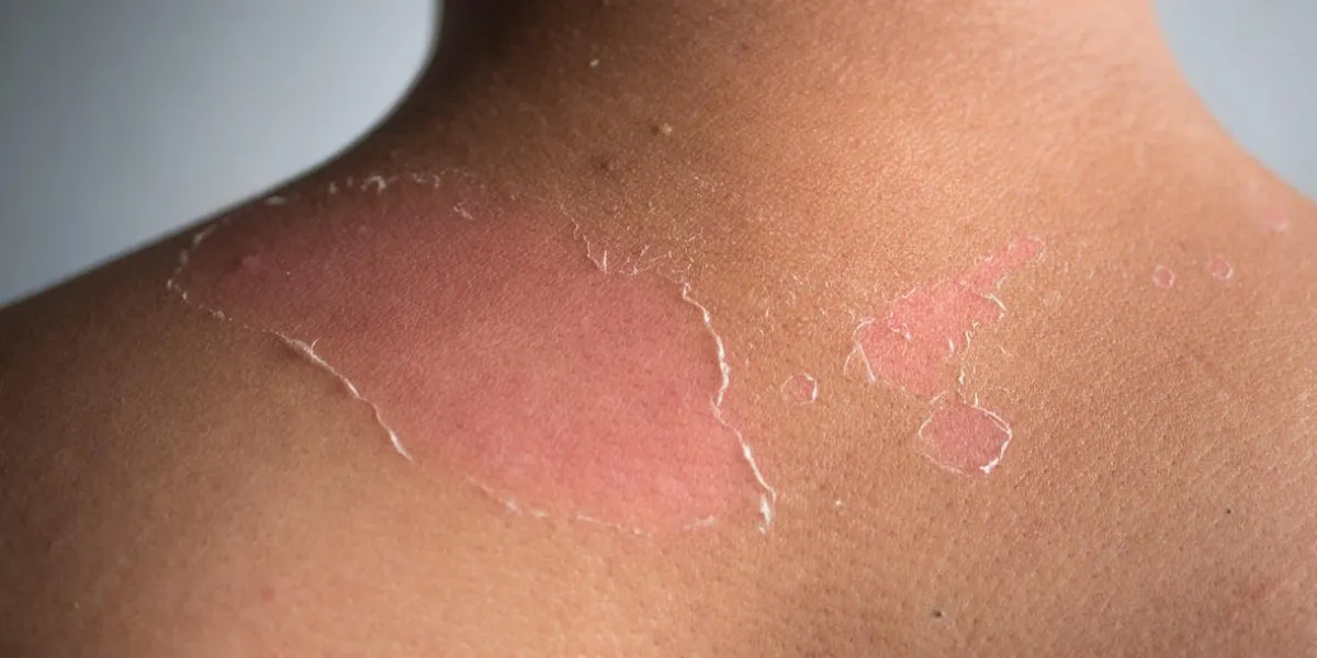 peeling skin at back and shoulder from sunburn effect on body of young man from sunbath at summer dangerous sunburn concept