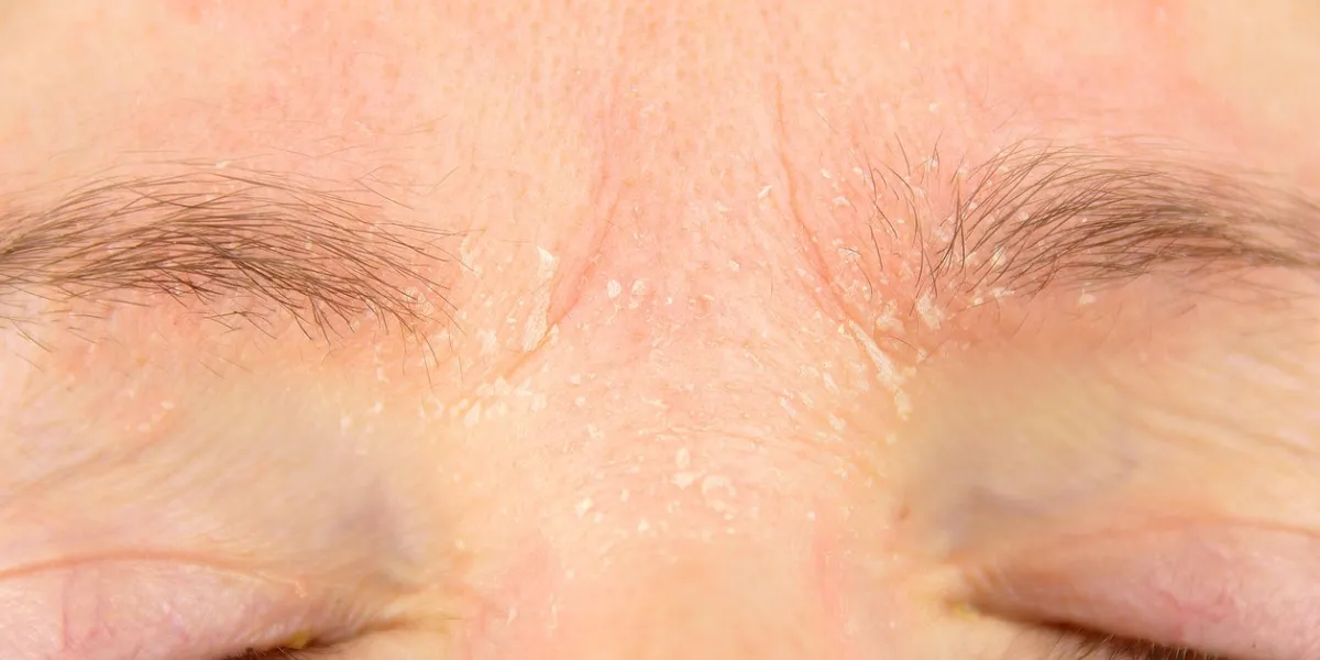 woman with symptom of atopic dermatitis on brow and brows