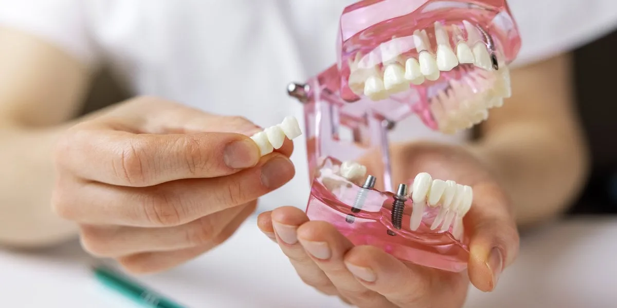 dentist implantologist showing dental bridge implant technology on human tooth jaw model