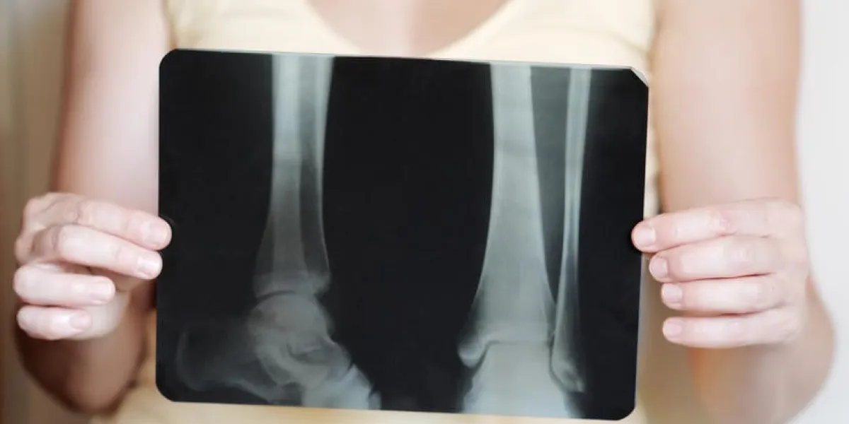 femme tenant une image radiographique des jambes