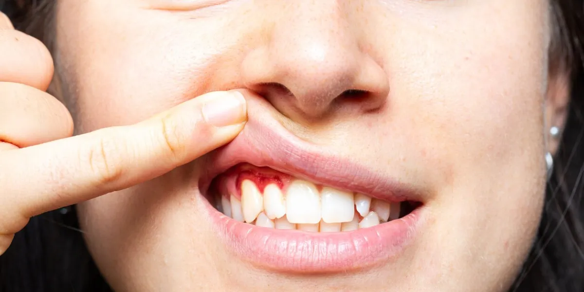 closeup of a girl with bleeding gums lifting her lip with her finger macro of a woman's mouth with red gums inflammation caused by gingivitis