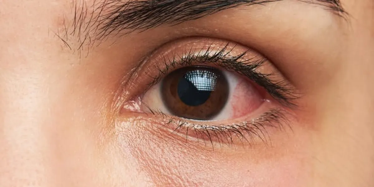 gros plan macro d'un œil de femme avec une infection