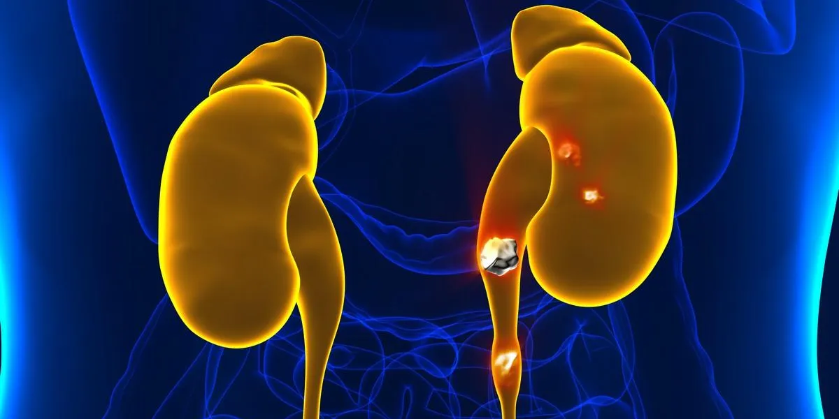 kidney stones anatomy pain male internal organ painful cristaline mineral cross section - 3d illustration