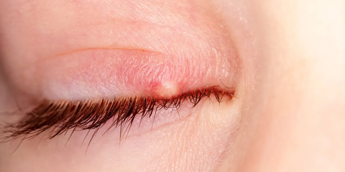 stye kid eye red skin barley bacteria virus