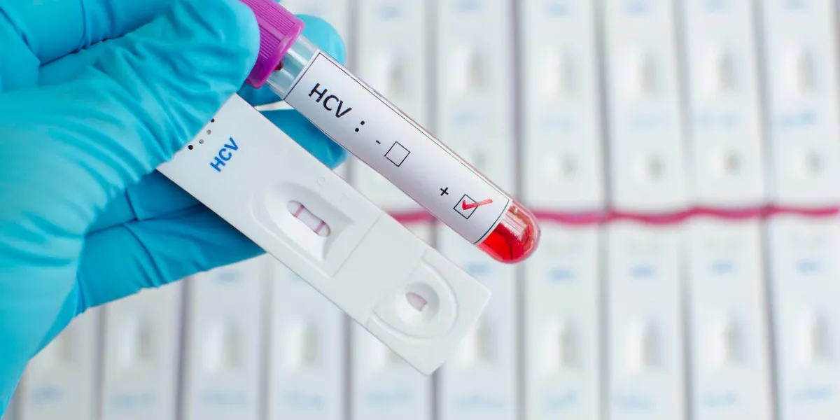 test du virus de l'hépatite c (hcv) en utilisant une cassette de test, le résultat a montré positif (double ligne rouge)