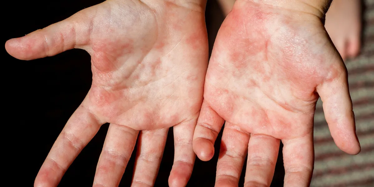 red rash on the hands of the palms of the child, rubella scarlet