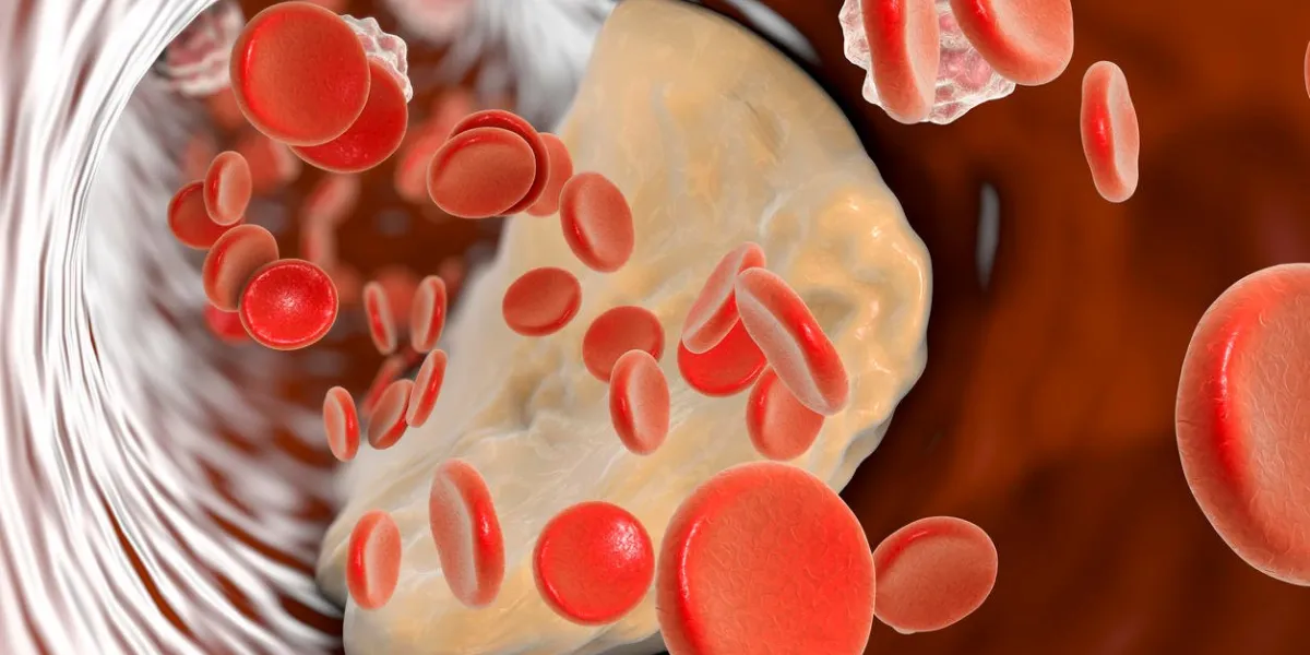 plaque d'athérome à l'intérieur de l'artère illustration 3d qui peut être utilisé pour la maladie coronarienne, l'athérosclérose, l'infarctus cérébral