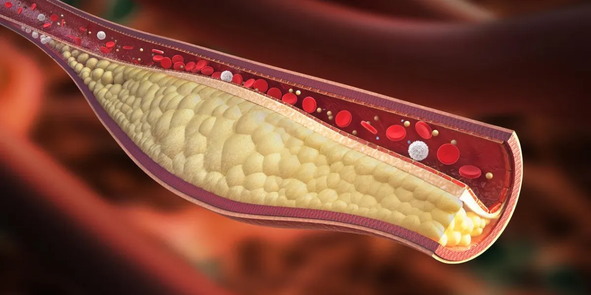 image de détail élevée de condition stable de plaque d'athérosclérose