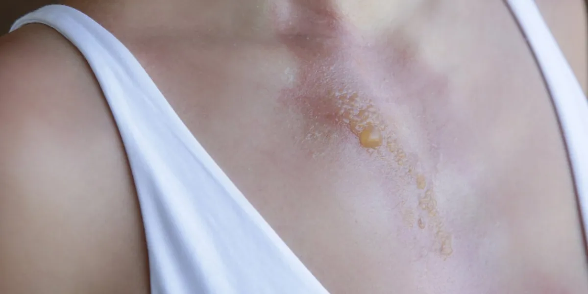 a second-degree burn with blister on woman's chest