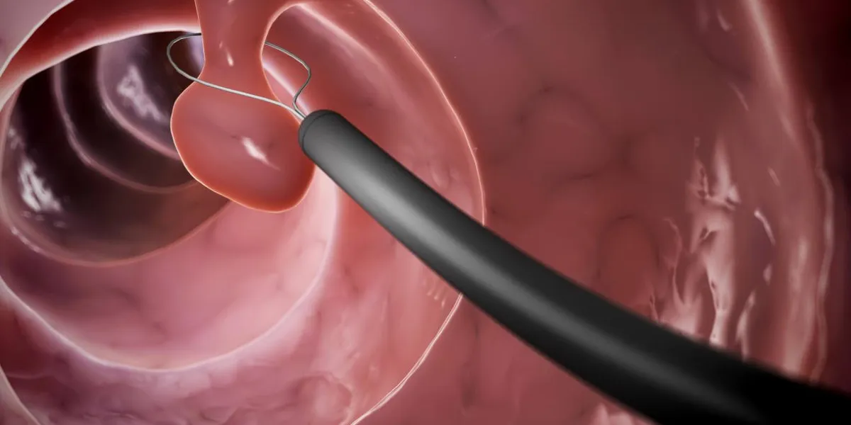 illustration de rendu 3d d'un retrait de polype