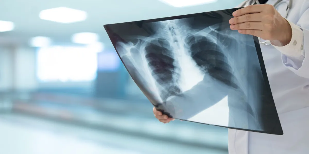 doctor radiology looking chest or lung x-ray image to diagnose pneumonia or inflamed lungs medical checkup concept