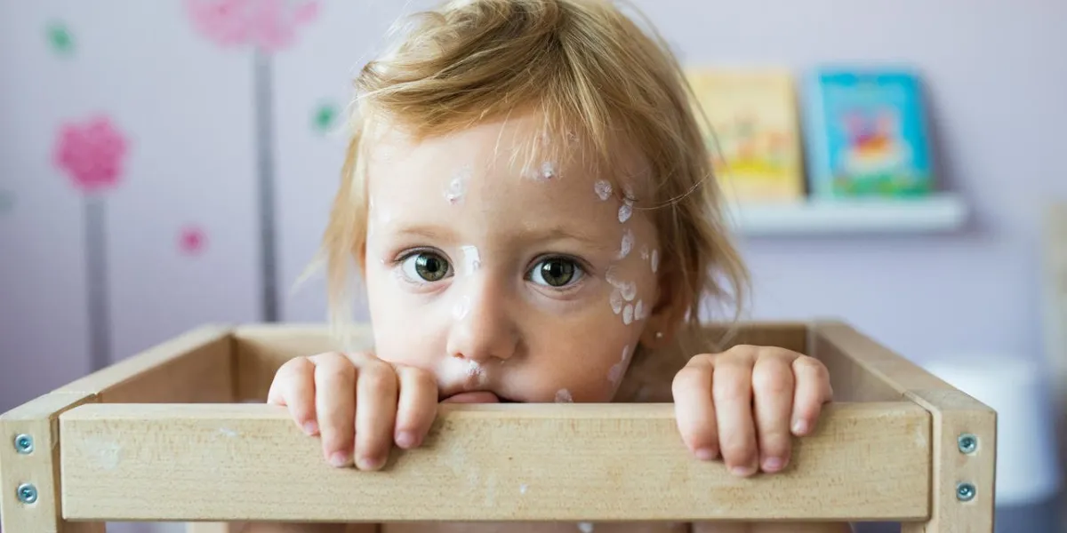 petite fille de deux ans à la maison malade de la varicelle, assis dans une chaise en bois crème antiseptique blanche appliquée à l'éruption