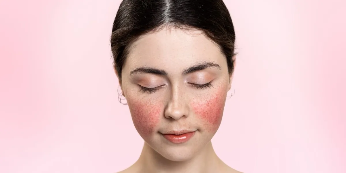 portrait of a beautiful woman with her eyes closed, showing inflamed blood vessels on her cheeks pink background copy space rosacea treatment concept