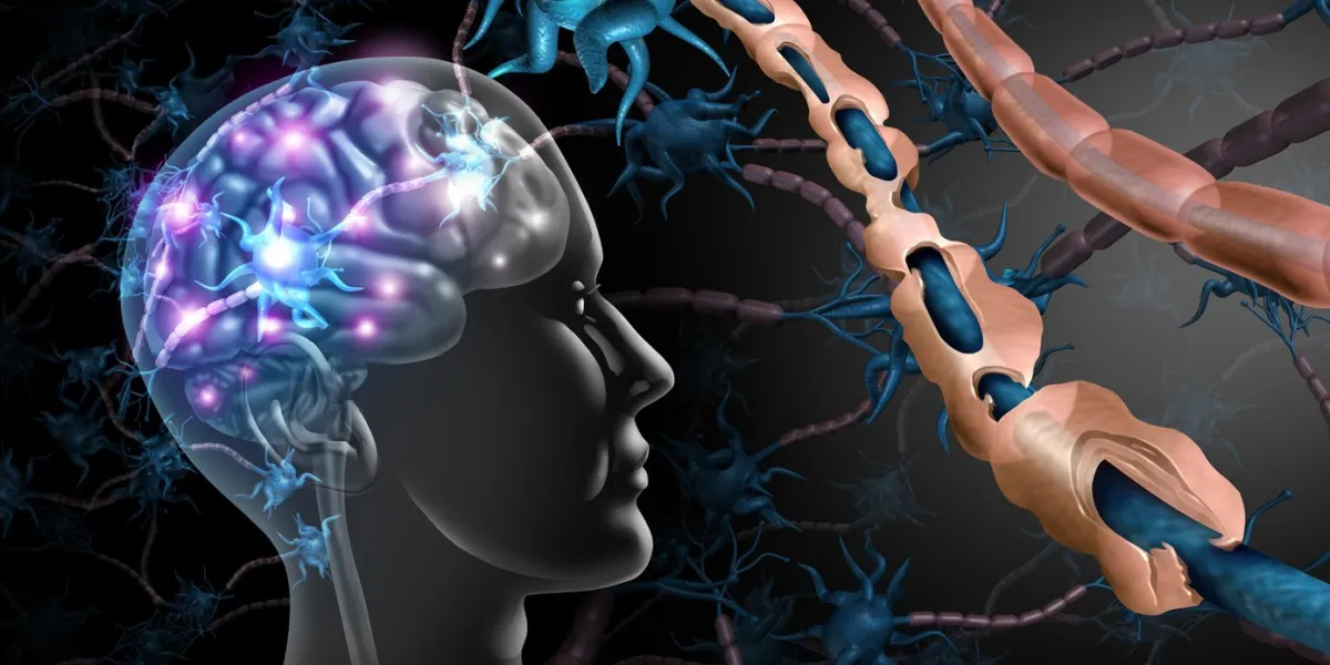 multiple sclerosis nerve disorder and damaged myelin or ms autoimmune disease with healthy nerve with exposed fibre with scarrred cell sheath loss with 3d illustration elements