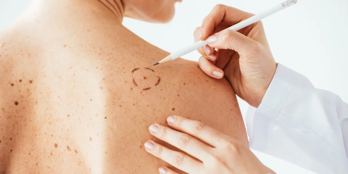 cropped view of dermatologist applying marks on skin of naked woman with melanoma isolated on white