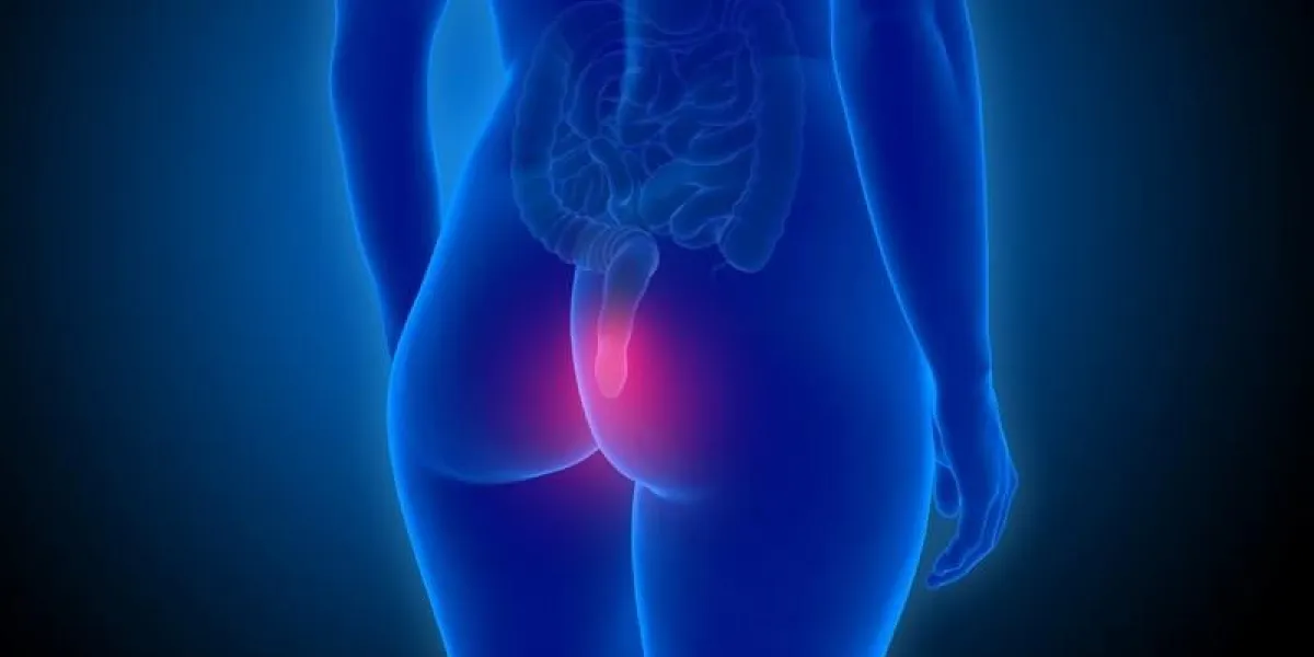 hämorrhoiden bei einer frau