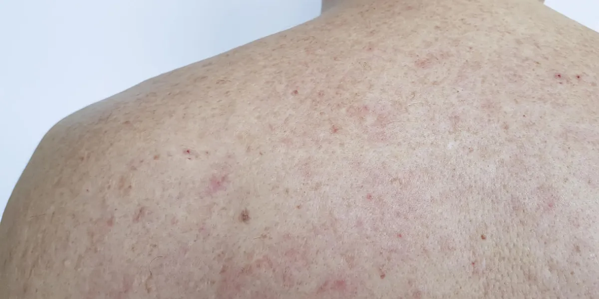 birthmark pimples on the back men bad skin