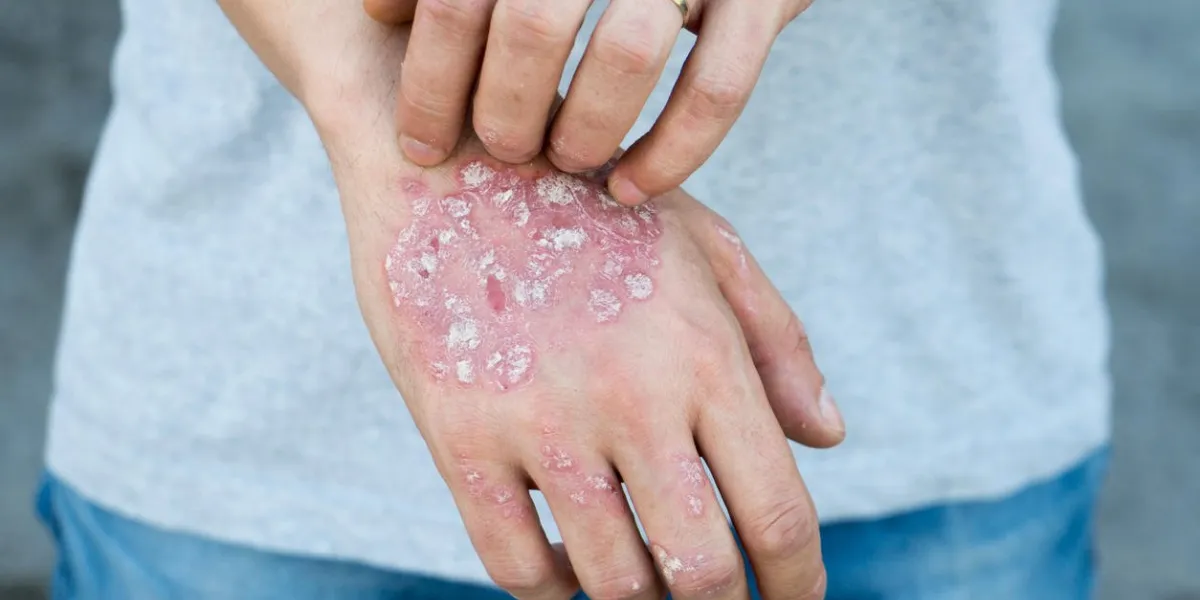 man scratch oneself, dry flaky skin on hand with psoriasis vulgaris, eczema and other skin conditions like fungus, plaque, rash and patches autoimmune genetic disease