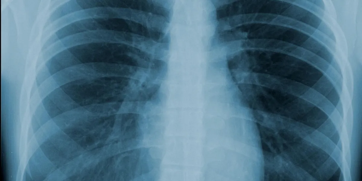 radiographie pulmonaire de face