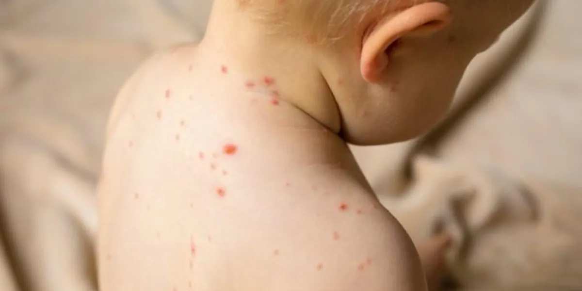 baby with chicken pox