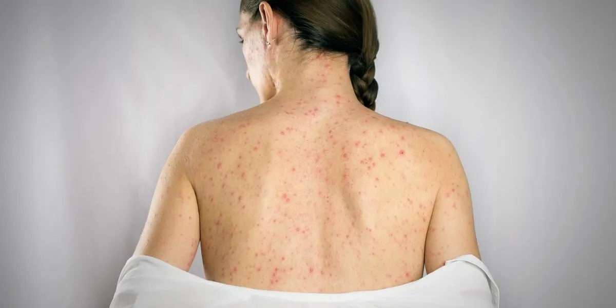 treatment chickenpox viral infection concept girls back skin rashes