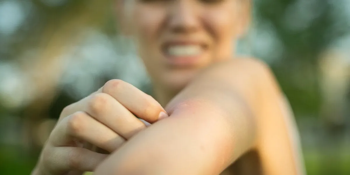 close up of a red mosquito bite on a person's arm, rubbing and scratching it outdoor in the park