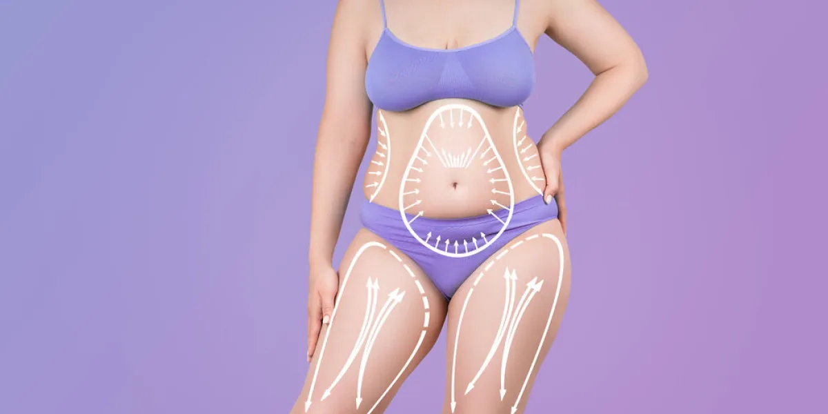 legs and belly liposuction, fat and cellulite removal concept, overweight female body with painted surgical lines and arrows on purple background