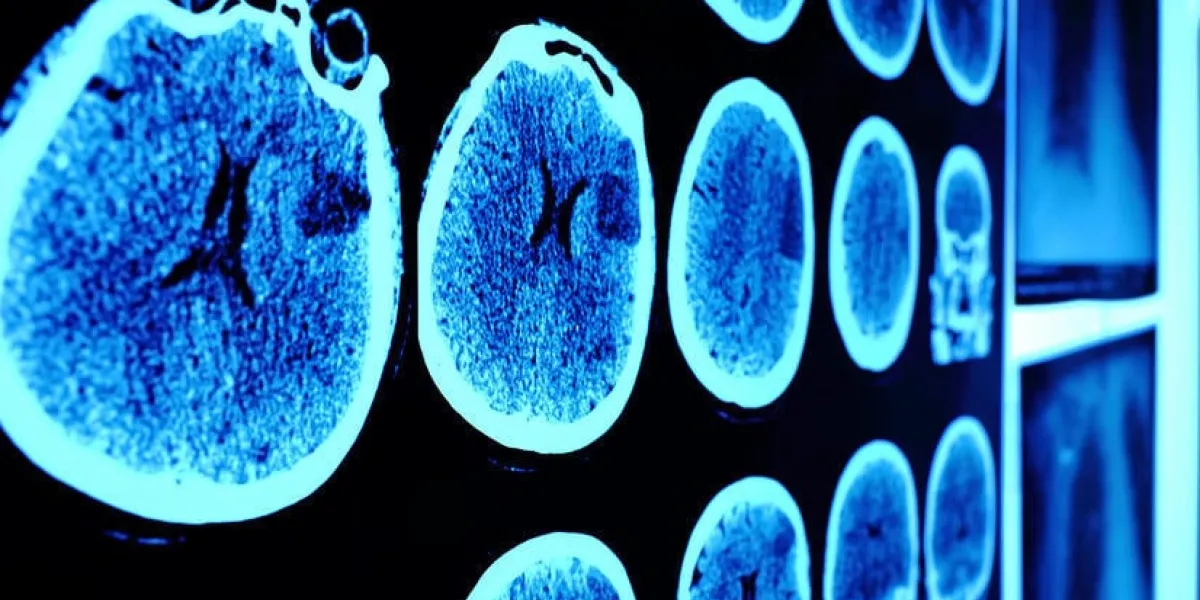 crâne ct scan image sur le mur en perspective