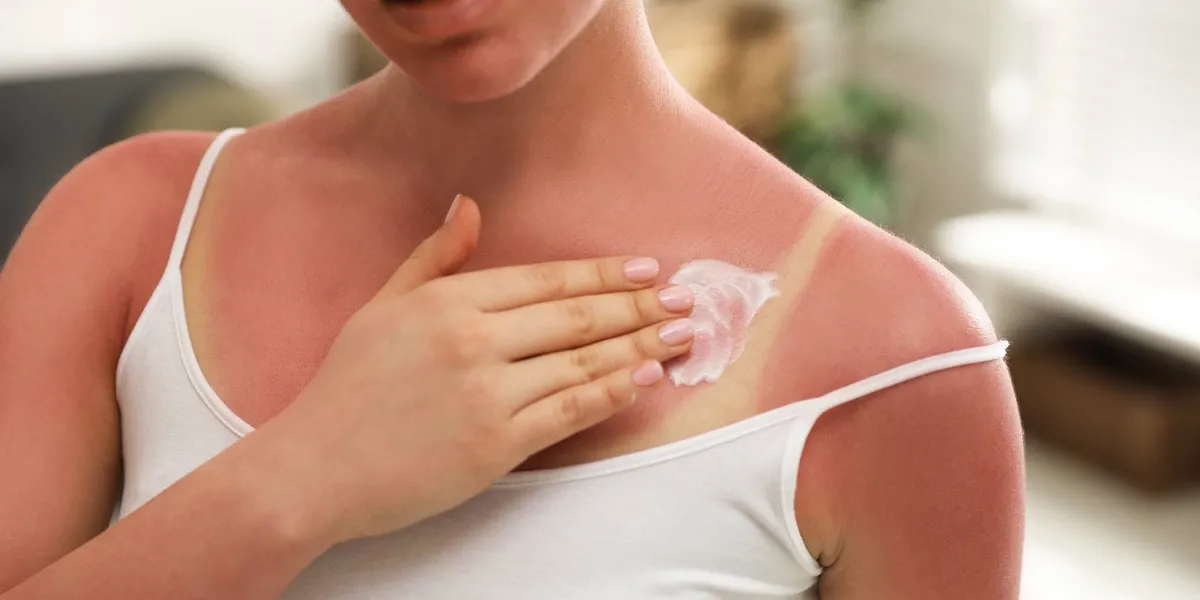woman applying cream on sunburn at home, closeup