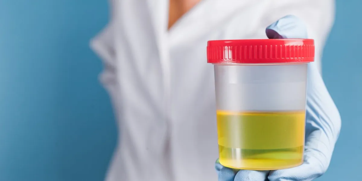 doctor in white uniform and blue medical gloves holding container for urine analysis urine testing for diseases and drugs in clinic